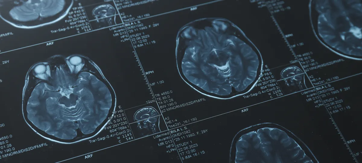 cognitive impairment
